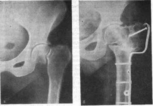Ложный сустав шейки бедра лечение. Проявления и лечение ложного сустава шейки бедра