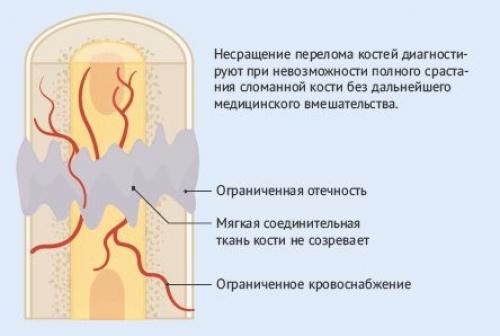 Плохо срастаются кости. Виды несращения костей. Наиболее вероятная причина несращения перелома кости.