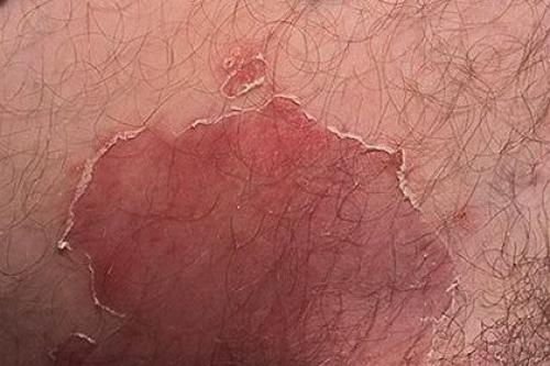 Паховый дерматит у мужчин. Зуд в паху у мужчин: причины