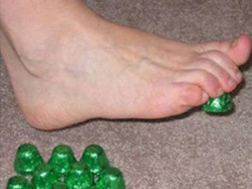 Шишка на суставе мизинца: причины, симптомы и лечение 07