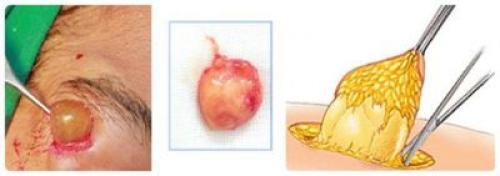 Стоит ли удалять липомы. Как лечить липомы? 05