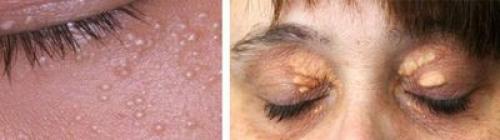 Стоит ли удалять липомы. Как лечить липомы? 01