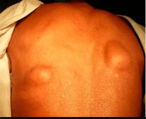 Липома это рак. Липома — доброкачественная опухоль