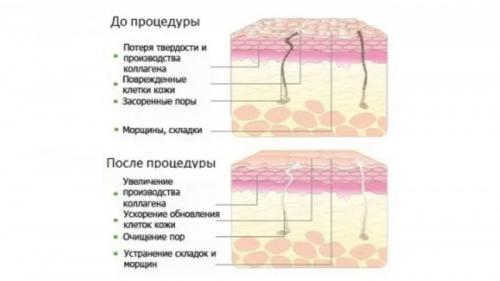 Как ухаживать за кожей после пилинга. Главные принципы ухода за кожей после пилинга химического 06