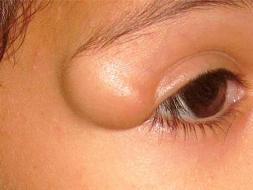 Читайте информацию о чем опасна атерома на плече. Симптомы