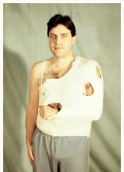 Импрессионный перелом хилл-сакса лечение. Нестабильность плечевого сустава