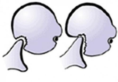 Импрессионный перелом хилл-сакса лечение. Нестабильность плечевого сустава