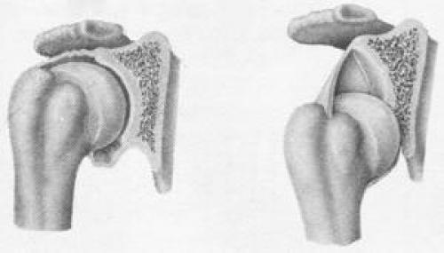 Повреждение хилл сакса плечевого сустава. Типичные повреждения плечевого сустава 03