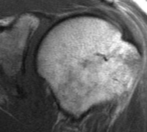 Повреждение хилл сакса плечевого сустава. Типичные повреждения плечевого сустава 01