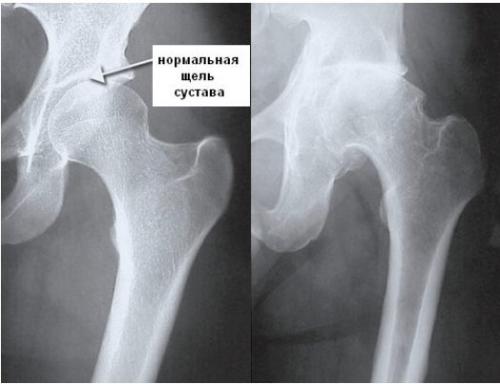 Лечение артроза тазобедренного сустава в домашних условиях народными средствами. Народные средства лечения артроза тазобедренного сустава: возможно или нет?