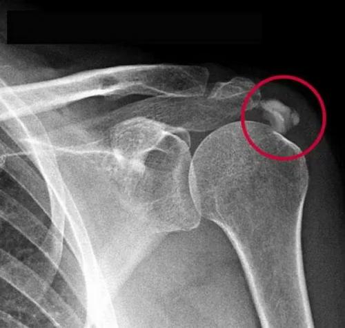 Отложение соли в суставах. Тревожные симптомы 07 Отложение соли в суставах. Тревожные симптомы 07