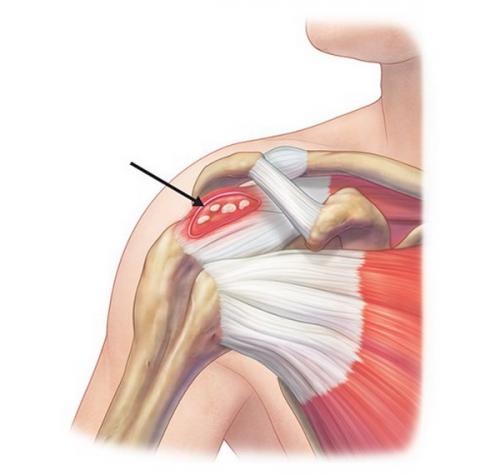 Отложение соли в суставах. Тревожные симптомы 06 Отложение соли в суставах. Тревожные симптомы 06
