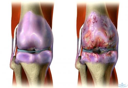 Как лечить суставы колен. Артроз коленных суставов или гонартроз