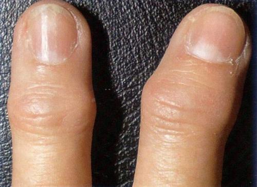 Какие культуры используют шишку на указательном пальце. Образование шишек и наростов на пальцах рук: причины, симптомы и лечение