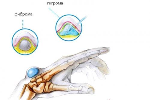Какие культуры используют шишку на указательном пальце. Образование шишек и наростов на пальцах рук: причины, симптомы и лечение
