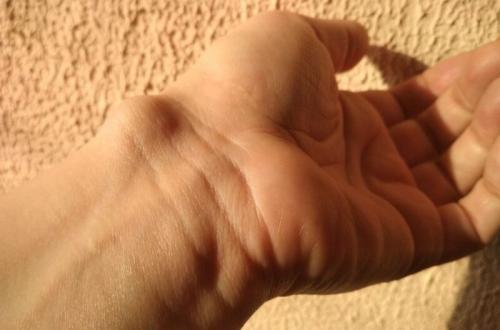 Какие культуры используют шишку на указательном пальце. Образование шишек и наростов на пальцах рук: причины, симптомы и лечение