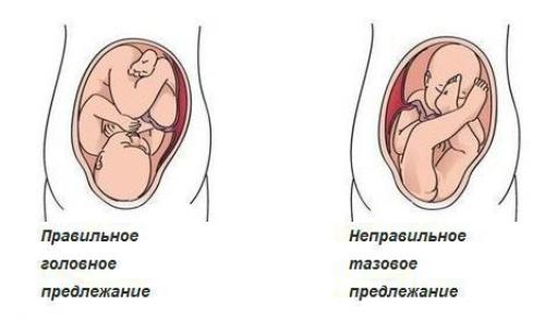 Дисплазия тазобедренных суставов у детей код по мк.  Эпидемиология 02