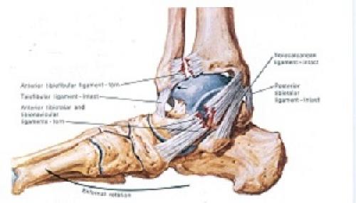 Повреждение связок голеностопного сустава. Принципы лечения повреждения связок голеностопного сустава 01