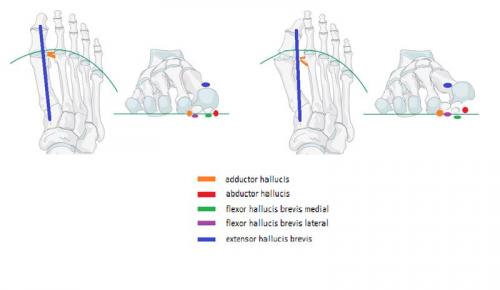 Шишечка как будто костная у основания пальца руки: что это такое и как это влияет на здоровье 01 Шишечка как будто костная у основания пальца руки: что это такое и как это влияет на здоровье 01