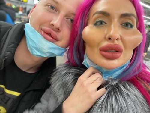 Большие скулы инстаграм. Как живется «Украинке с самыми большими скулами» — фото до пластики и что с ее личной жизнью