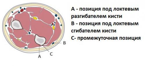 Перелом лучезапястного сустава руки со смещением. Перелом шейки и головки лучевой кости 03 Перелом лучезапястного сустава руки со смещением. Перелом шейки и головки лучевой кости 03