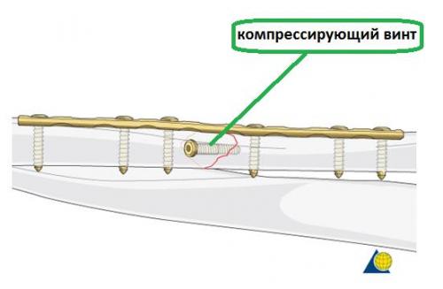 Перелом лучезапястного сустава руки со смещением. Перелом шейки и головки лучевой кости 05 Перелом лучезапястного сустава руки со смещением. Перелом шейки и головки лучевой кости 05