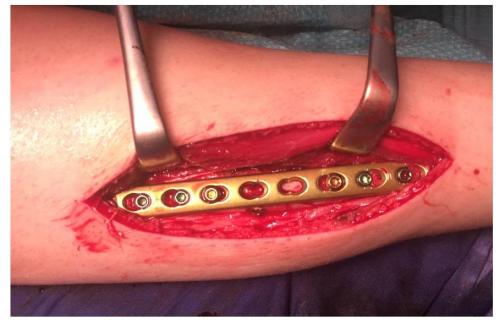 Перелом лучезапястного сустава руки со смещением. Перелом шейки и головки лучевой кости 06 Перелом лучезапястного сустава руки со смещением. Перелом шейки и головки лучевой кости 06