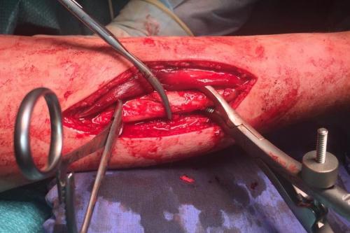 Перелом лучезапястного сустава руки со смещением. Перелом шейки и головки лучевой кости 02 Перелом лучезапястного сустава руки со смещением. Перелом шейки и головки лучевой кости 02