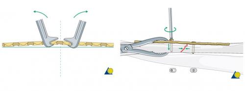 Перелом лучезапястного сустава руки со смещением. Перелом шейки и головки лучевой кости 04 Перелом лучезапястного сустава руки со смещением. Перелом шейки и головки лучевой кости 04