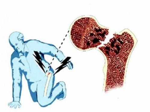 Перелом шейки бедра у пожилых людей и молодых.. Анатомия и кровоснабжение 07 Перелом шейки бедра у пожилых людей и молодых.. Анатомия и кровоснабжение 07