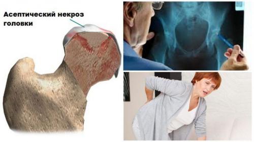 Восстанавливаемся после перелома шейки бедра.. Причины и предпосылки для получения травмы