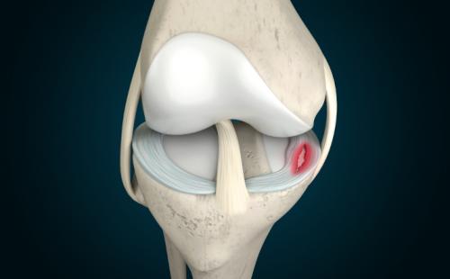 Операция при разрыве мениска: что нужно знать 02