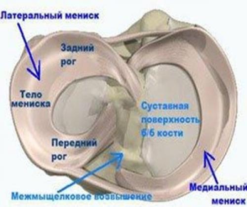 Может ли хирургическое вмешательство быть необходимым при повреждении рогов медиального мениска. Как вылечить повреждение?