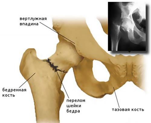 Перелом шейки бедра и методы восстановления. Причины и факторы риска 04 Перелом шейки бедра и методы восстановления. Причины и факторы риска 04