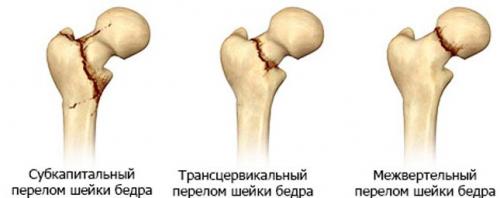 Сапожок при переломе шейки бедра. Деротационный сапожок при переломе бедра: что это и зачем он нужен?