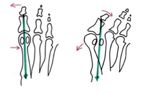 Какие факторы могут увеличивать риск развития растущей косточки на указательном пальце руки. Почему возникает такая деформация?