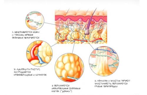 Как убрать целлюлит 3 стадии.  Нарушение микроциркуляции крови и лимфы