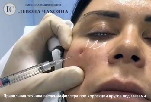 Как избавиться от синяков под глазами косметология. Какие препараты от кругов (синяков) под глазами можно использовать?