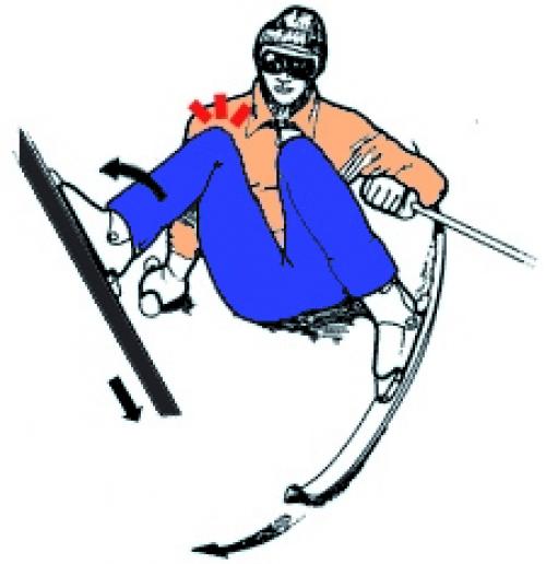 Повреждения передней крестообразной связки. Хирургическое лечение разрыва передней крестообразной связки колена 02