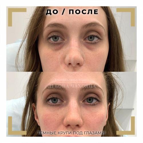 Тонкая кожа под глазами косметология. Как можно убрать круги и сколько длится эффект?