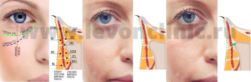 Тонкая кожа под глазами.  Мезотерапия 01