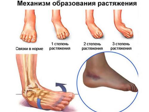 Какие лекарства могут быть назначены для лечения после ревизии нагрузки на ногу. Терапия повреждений легкой и средней степени тяжести