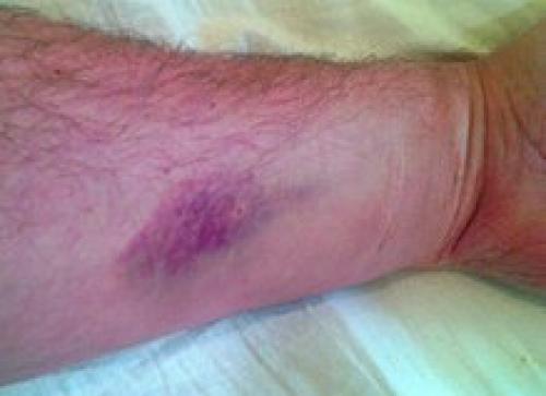 Как избавиться от синяка за три дня. Почему гематома меняет цвет 03