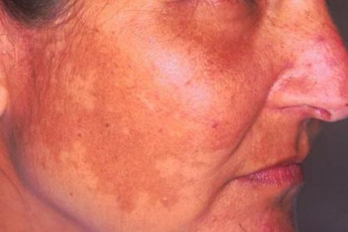 Как избавиться от пигментных пятен. Почему появляются пигментные пятна 04 Как избавиться от пигментных пятен. Почему появляются пигментные пятна 04