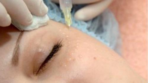 Мезотерапия вокруг глаз, как спасение от мешков. Эффект от мезотерапии 02