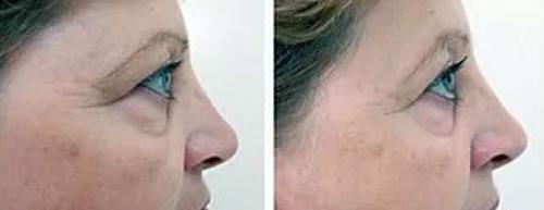 Мезотерапия вокруг глаз, как спасение от мешков. Эффект от мезотерапии 05