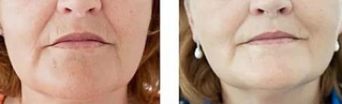 Мезотерапия вокруг глаз, как спасение от мешков. Эффект от мезотерапии 04