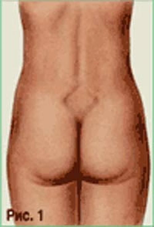 Размеры таза норма для родов. Как измеряют малый таз?