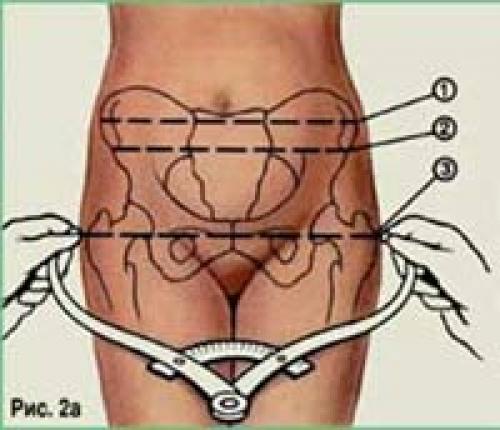 Размеры таза норма для родов. Как измеряют малый таз?
