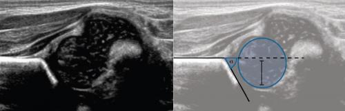 Протокол узи тазобедренных суставов у детей. УЗИ тазобедренных суставов у младенцев